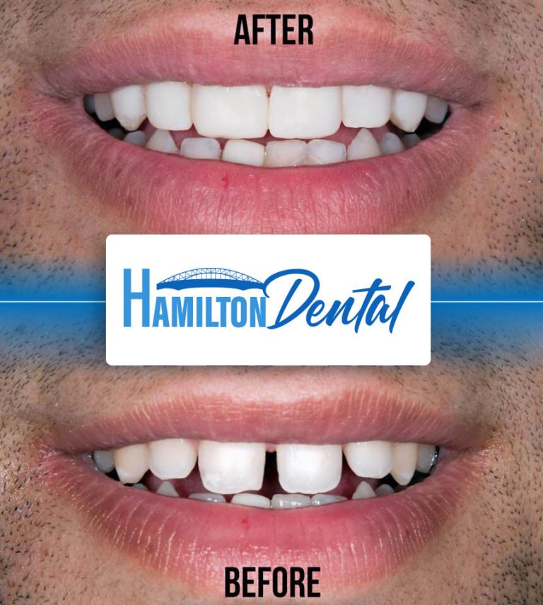 Before and After Photos from Hamilton Dental Patients