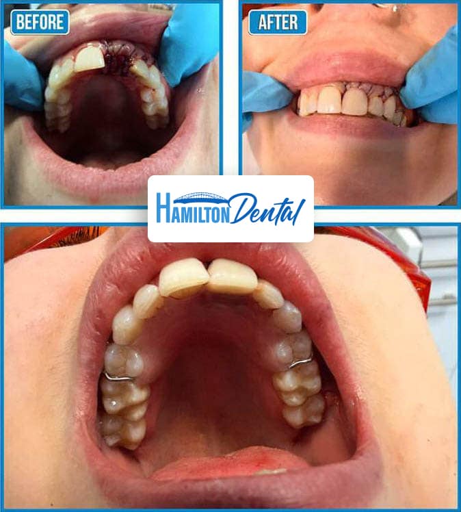 Dental Implants Before and After Hamilton