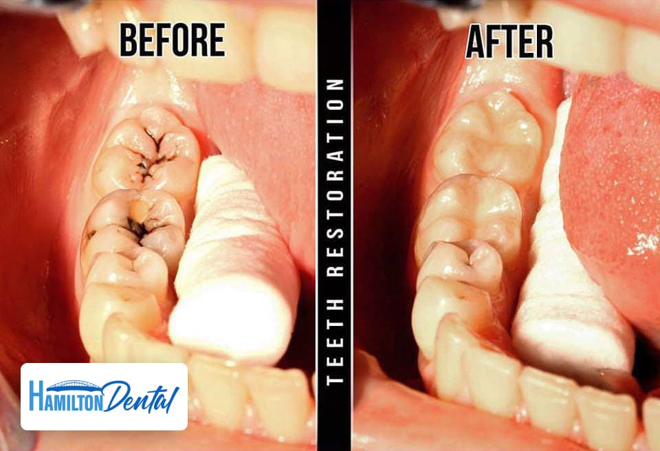 Dental Implants Hamilton Before and After