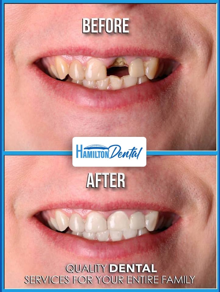 Dental Implants Pictures Hamilton Before and After