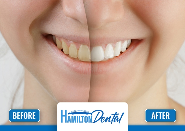 Dental Whitening Hamilton 1