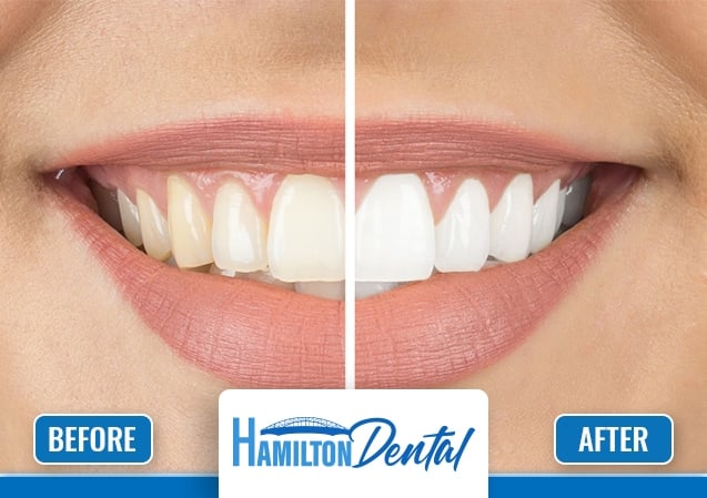 Dental Whitening Hamilton 2