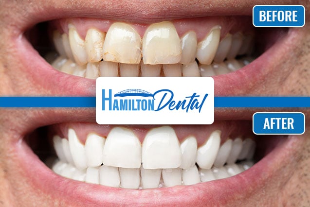 Teeth Whitening Before and After Hamilton 2