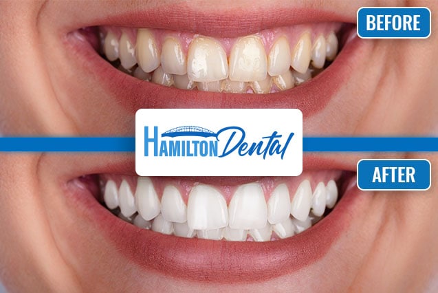 Teeth Whitening Before and After Hamilton 3