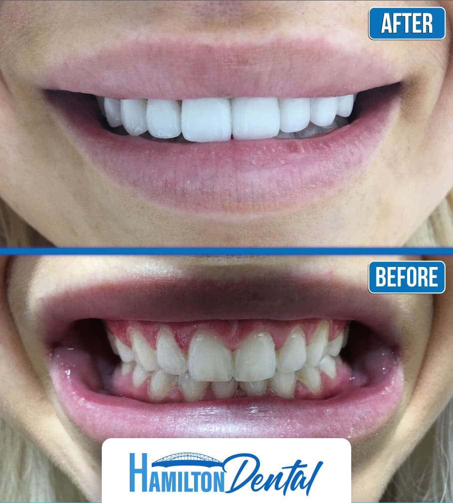 Tooth Implants Before and After Pictures Hamilton