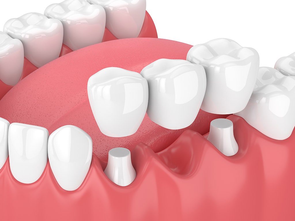 Dental Bridges for Tooth Loss 
