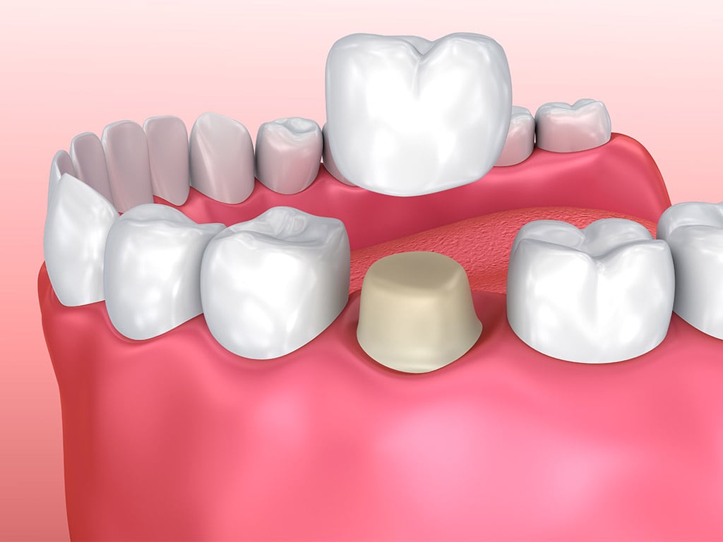 Dental Crowns Hamilton