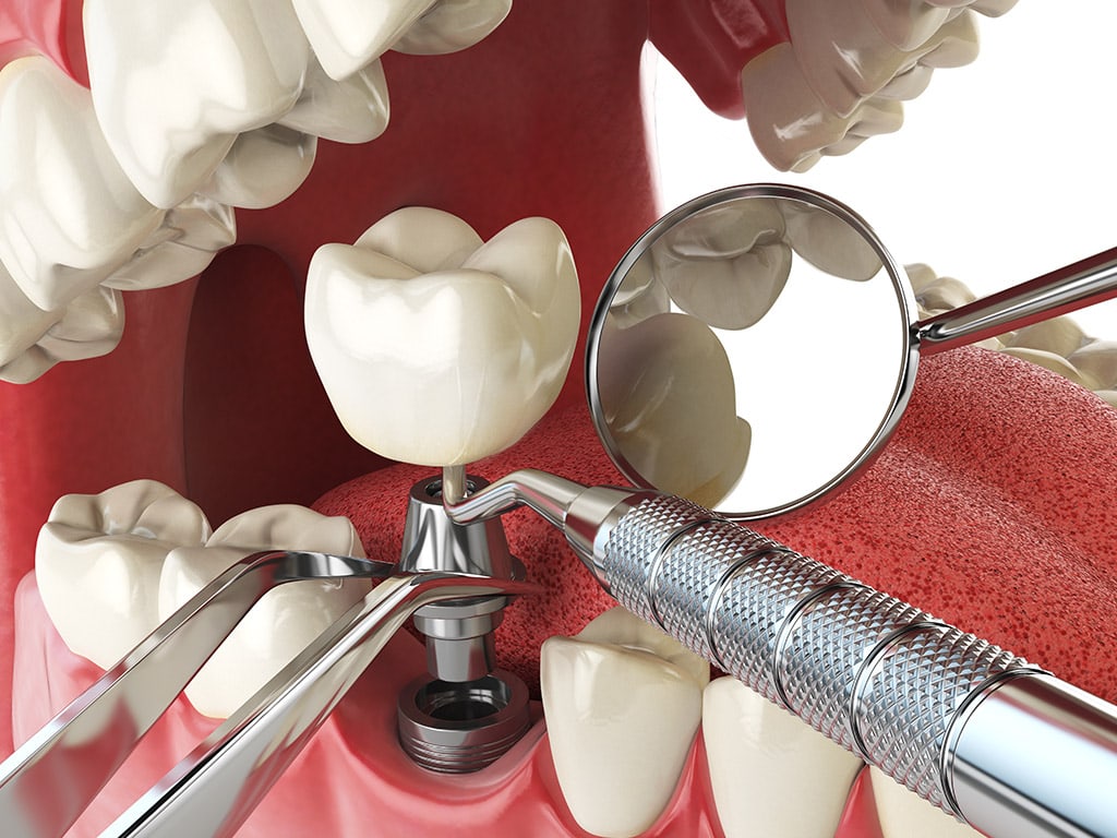 Dental Implant Surgery in Hamilton
