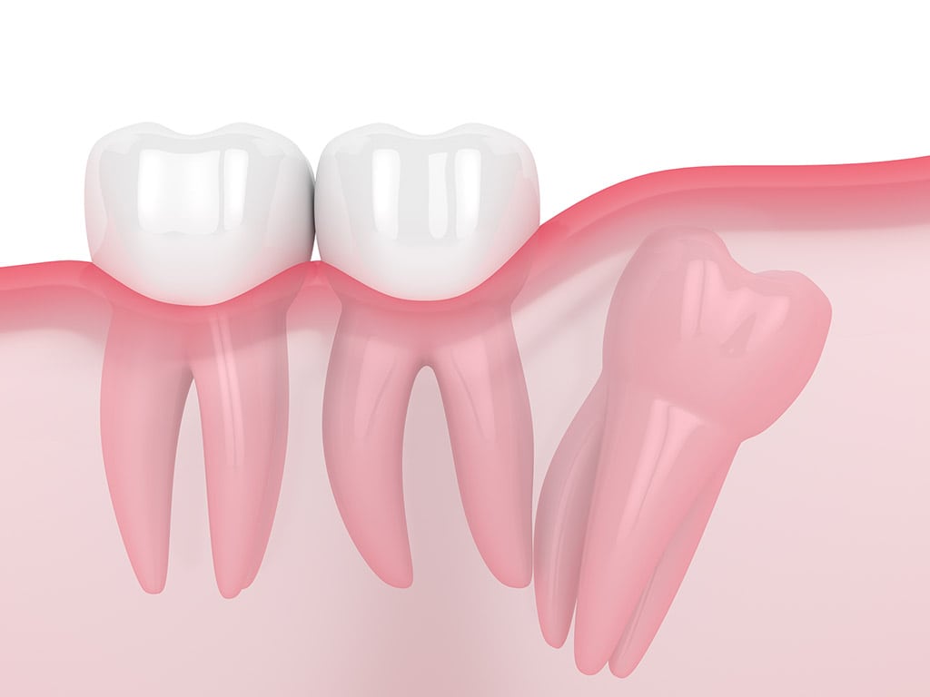 Distal Impacted Wisdom Tooth