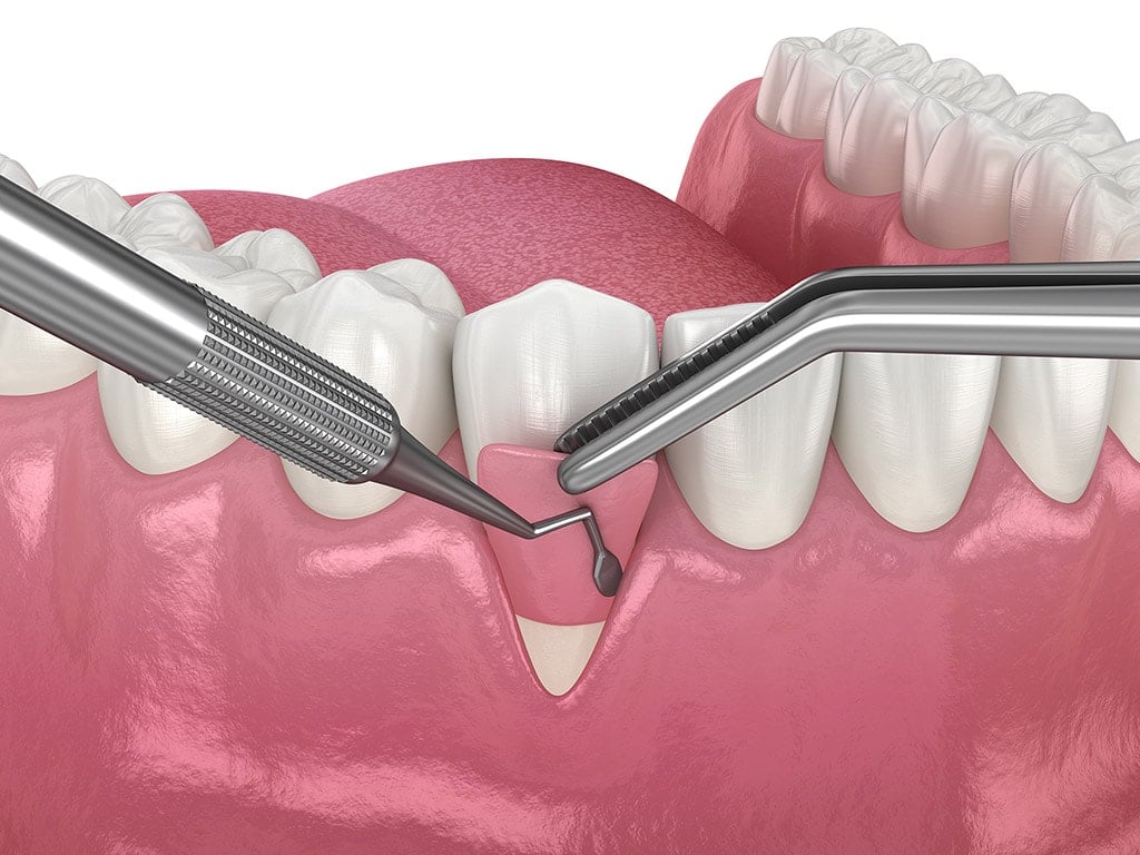 Gum Grafting Surgery in Hamilton