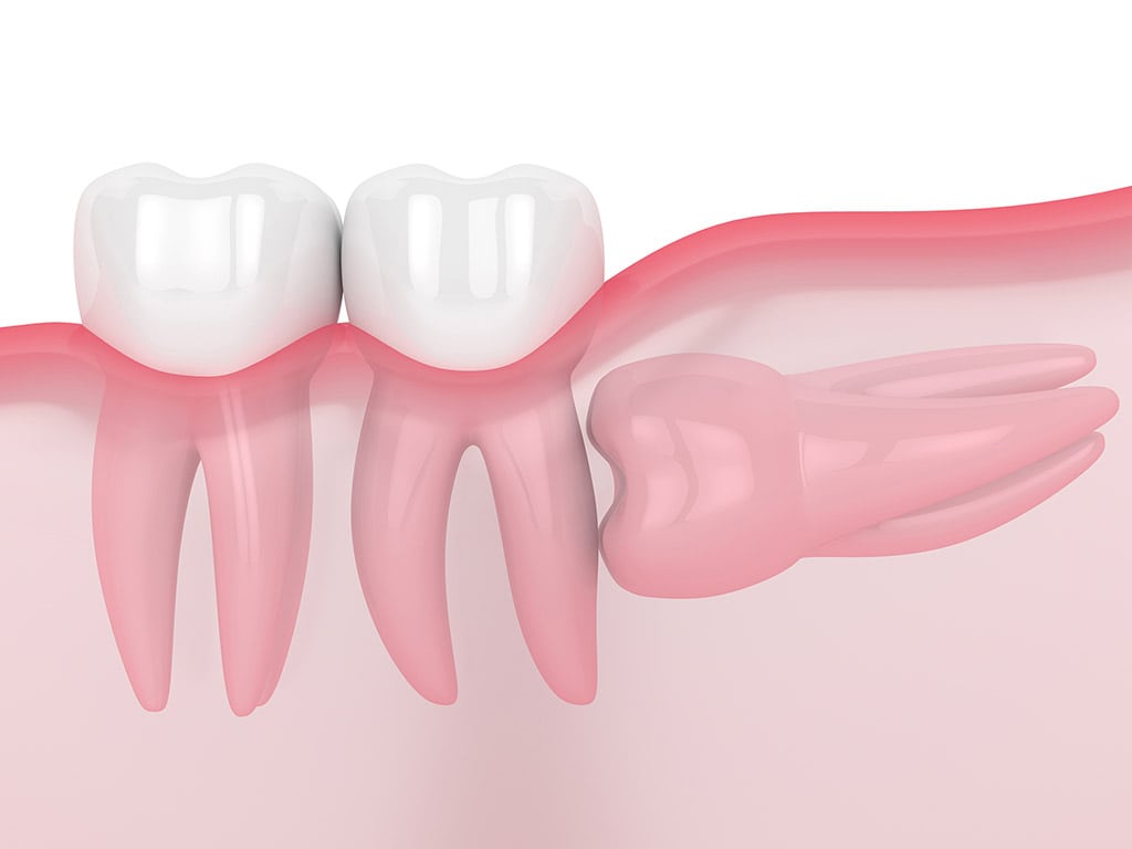 Horizontal Impacted Wisdom Tooth