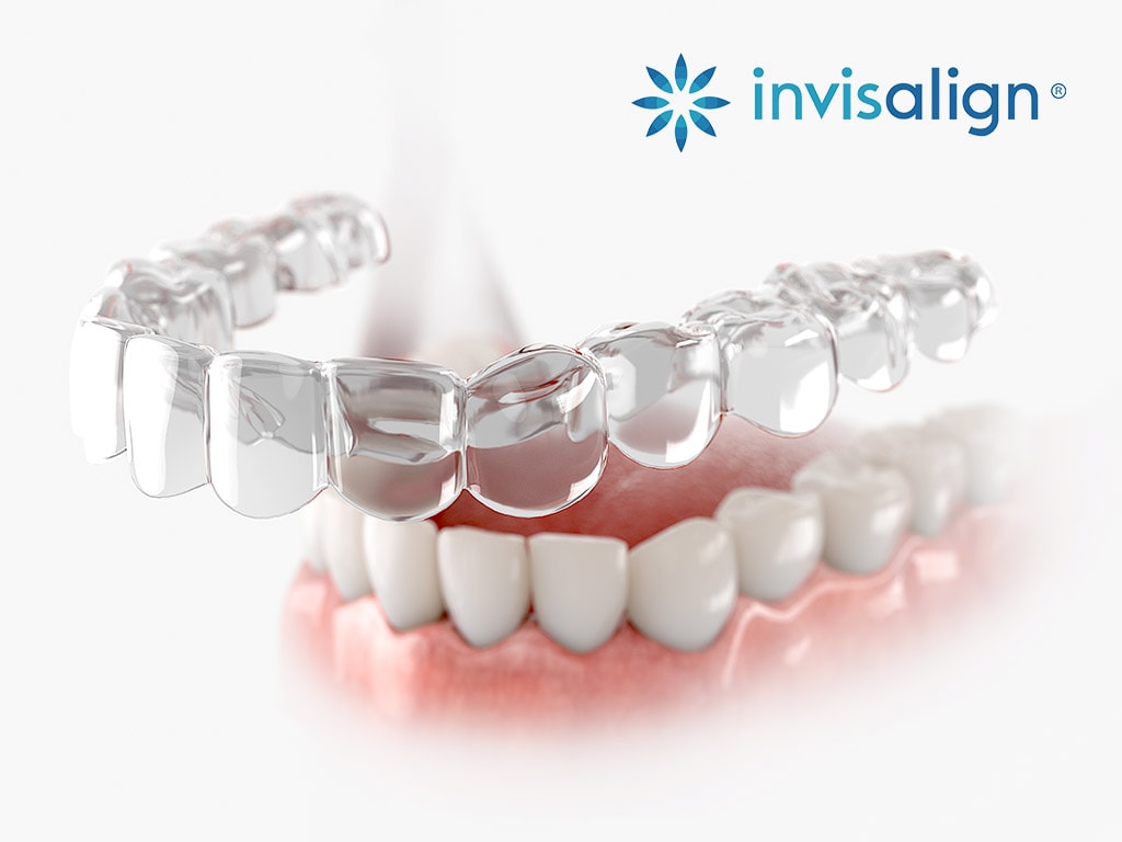 Invisalign Braces