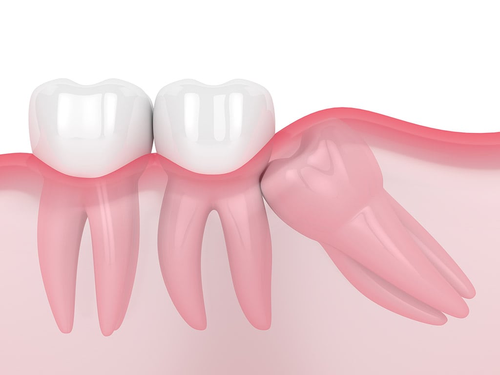 Mesial Impacted Wisdom Tooth