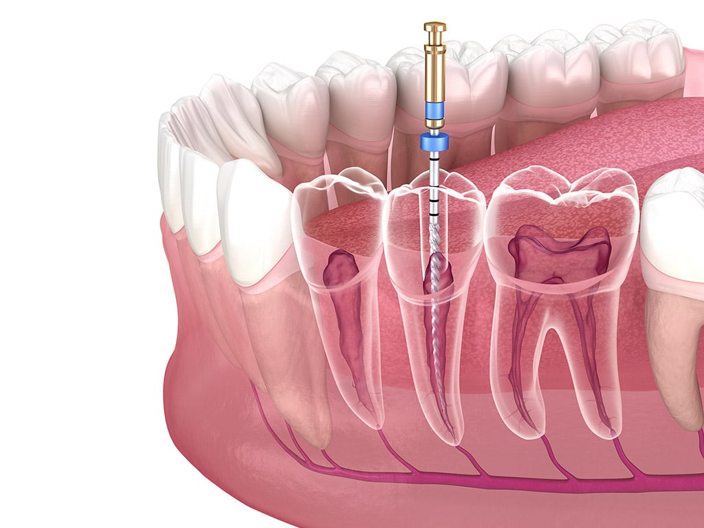 Root Canal Surgery in Hamilton