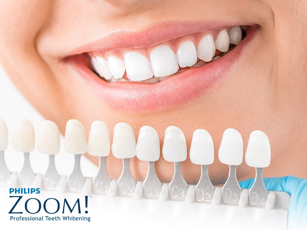 Dental Teeth Whitening in Hamilton