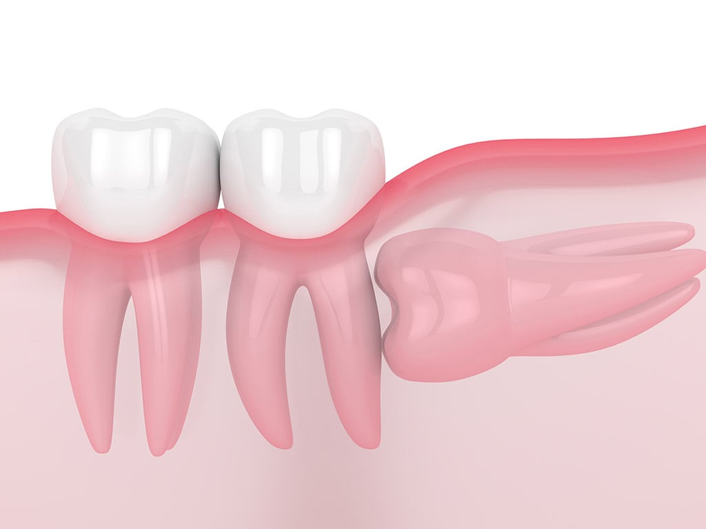 Tooth Extractions & Wisdom Tooth Removal in Hamilton