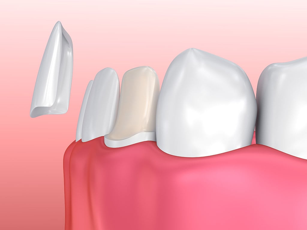 Porcelain Teeth Veneers Hamilton