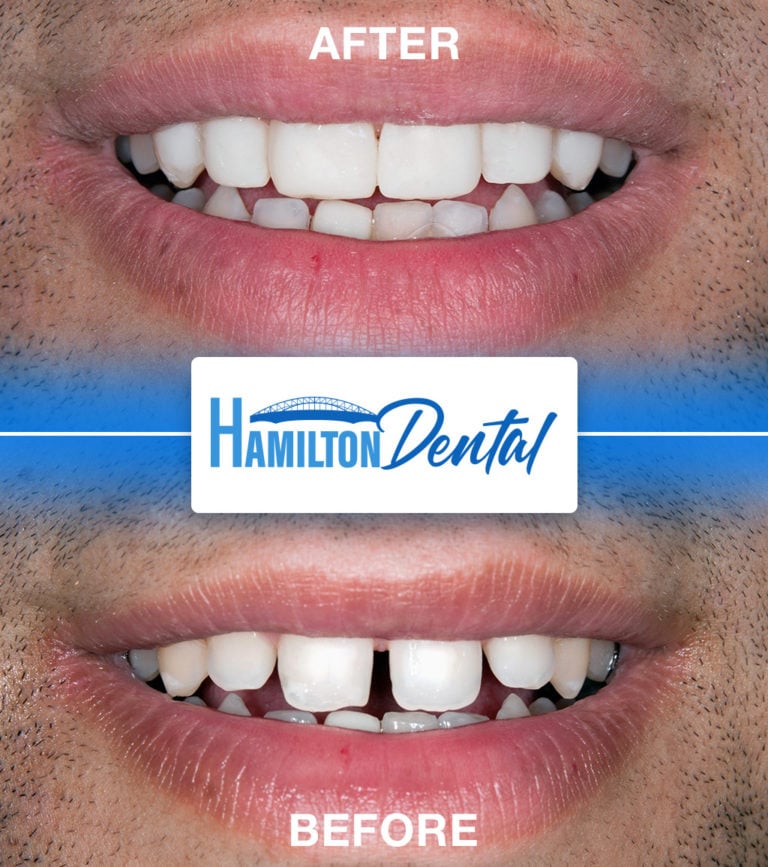 How Much Do Veneers Cost in Canada?