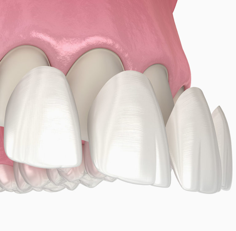 How Much Do Veneers Cost in Canada?