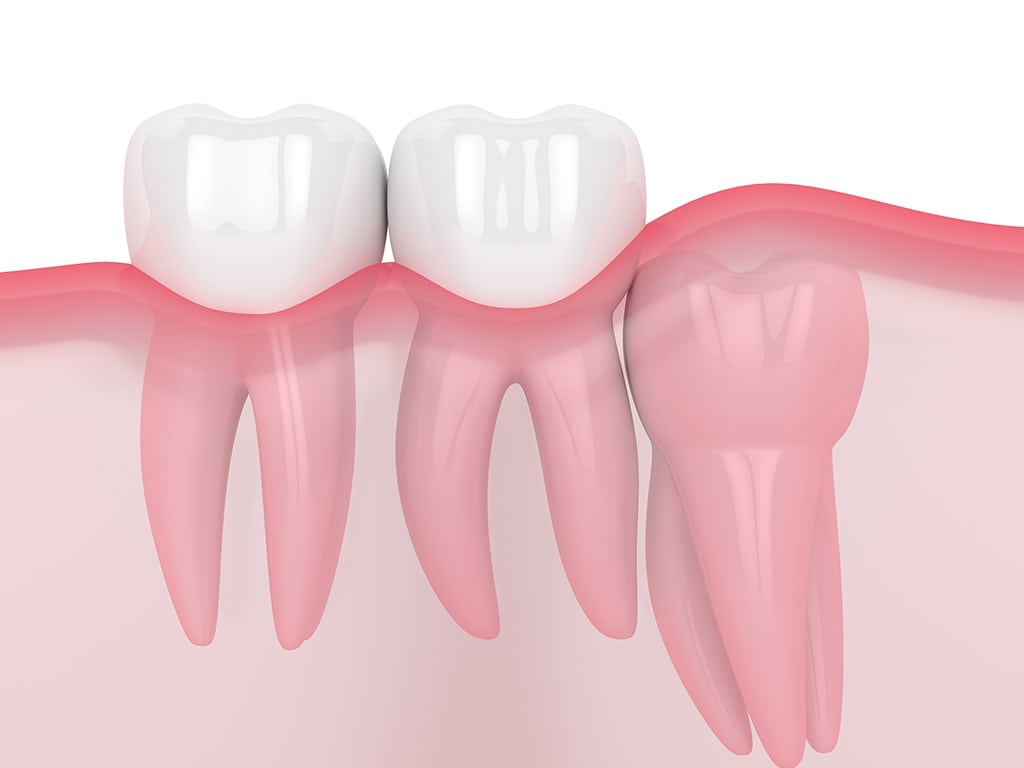 Vertical Impacted Wisdom Tooth