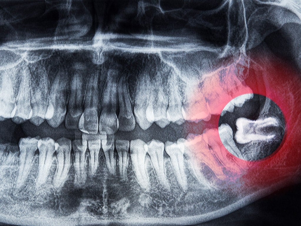 Wisdom Teeth Extraction Hamilton, ON