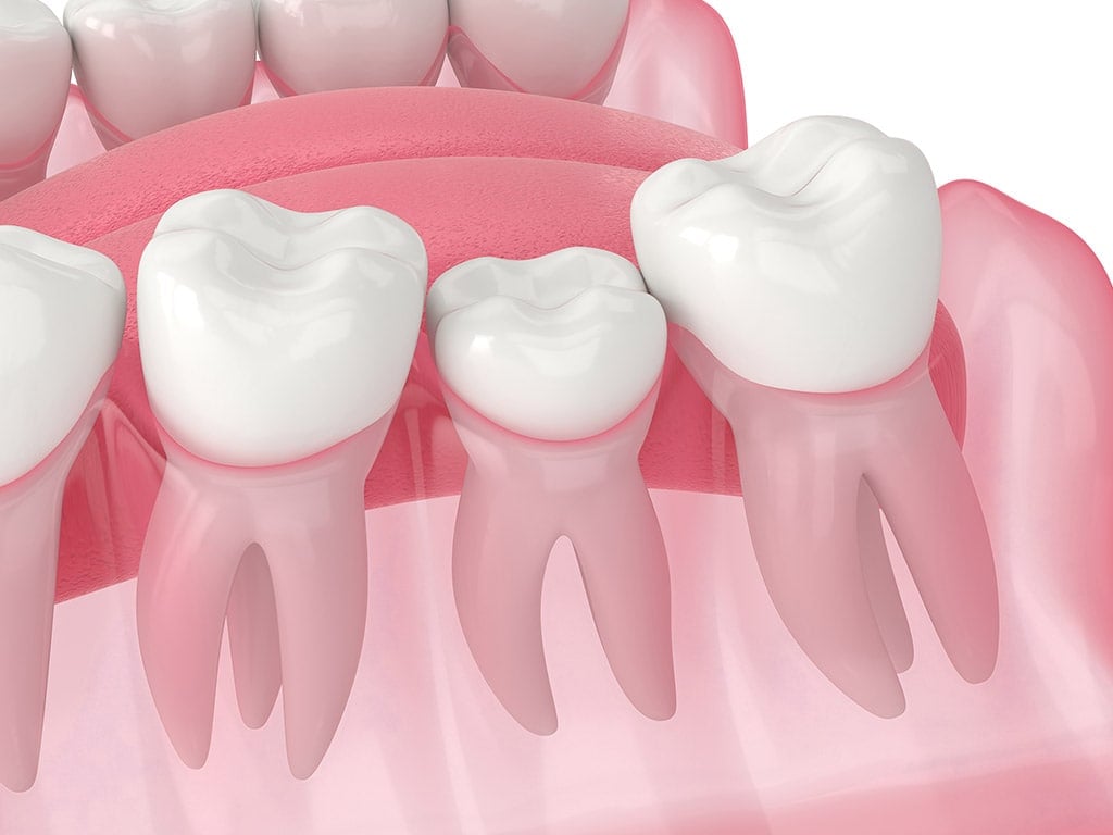 Wisdom Tooth Extraction Adjacent Teeth Protection Hamilton