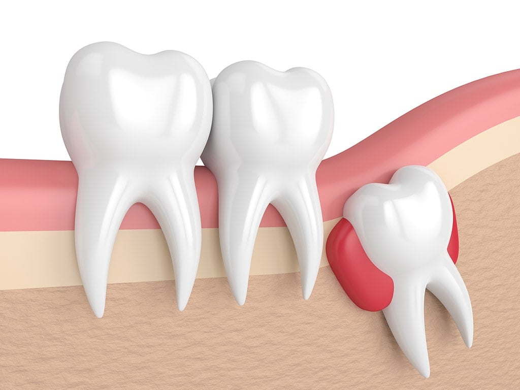 Wisdom Tooth Extraction Cyst and Tumor Prevention Hamilton