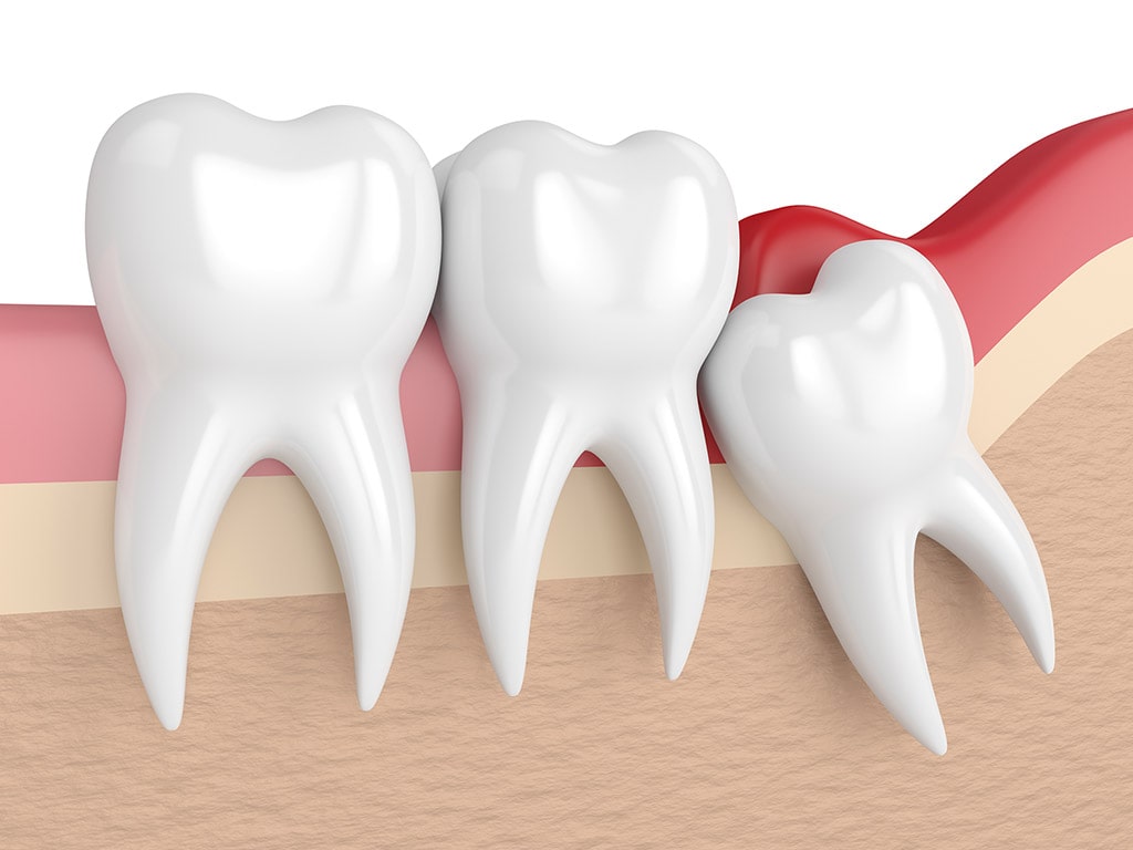 Wisdom Tooth Extraction Inflammation and Infection Hamilton