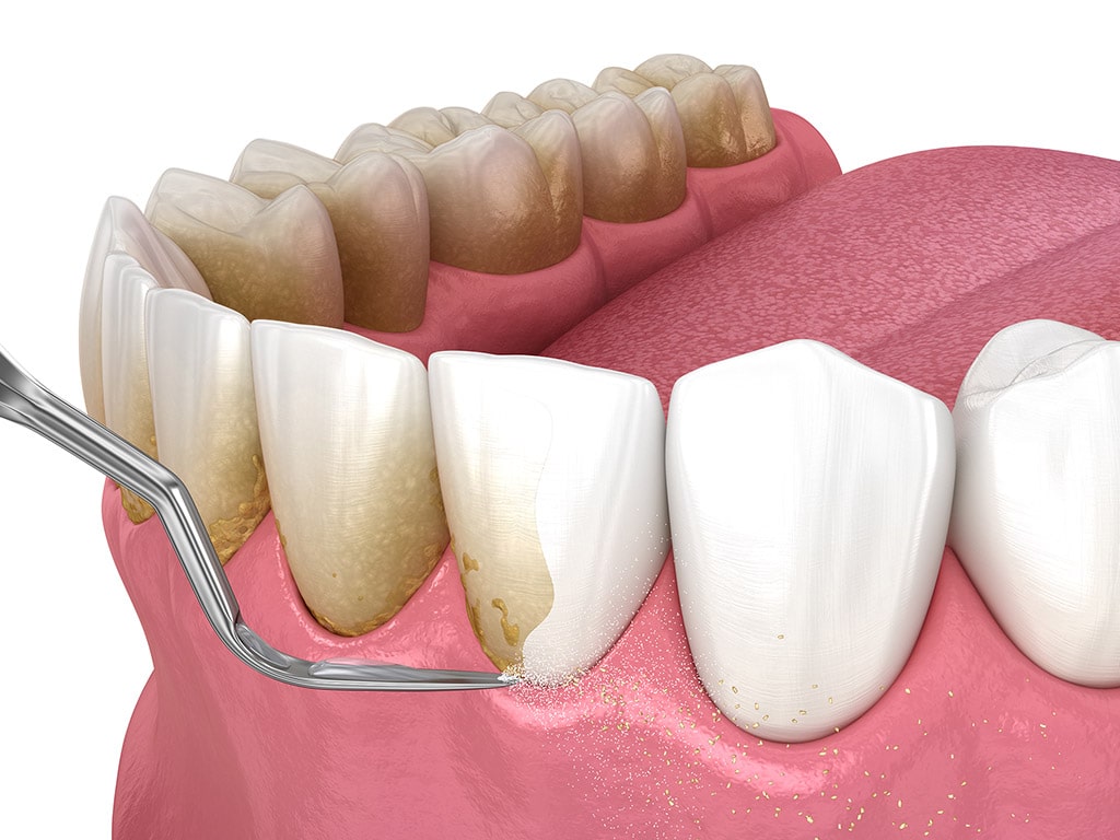 Teeth Scaling Hamilton Dental