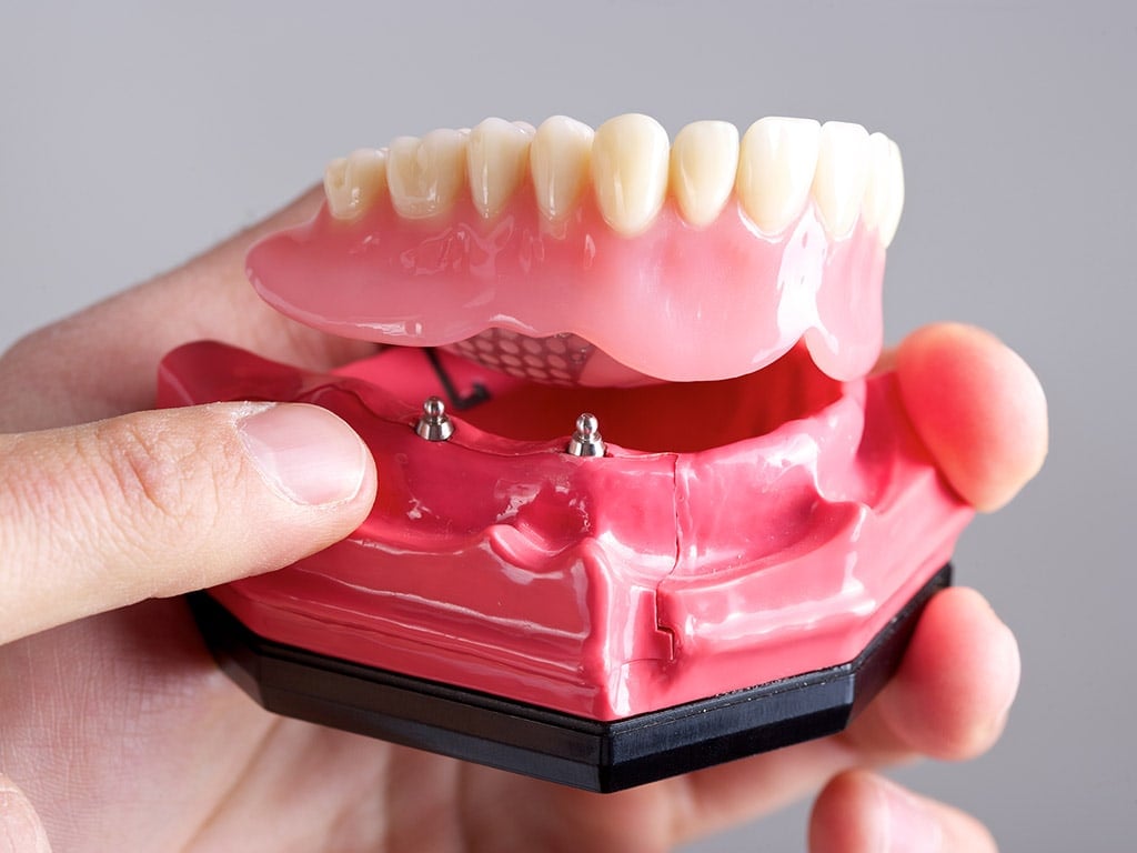 Implant Supported Dentures Hamilton Dental