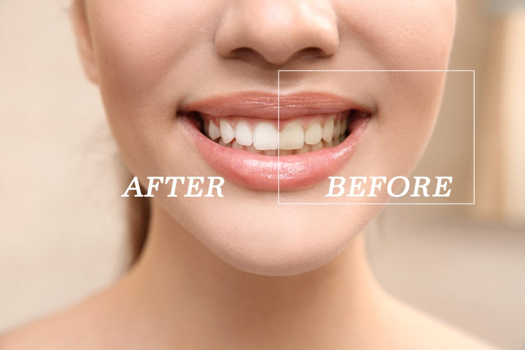 Result of teeth whitening. Smiling young woman, closeup