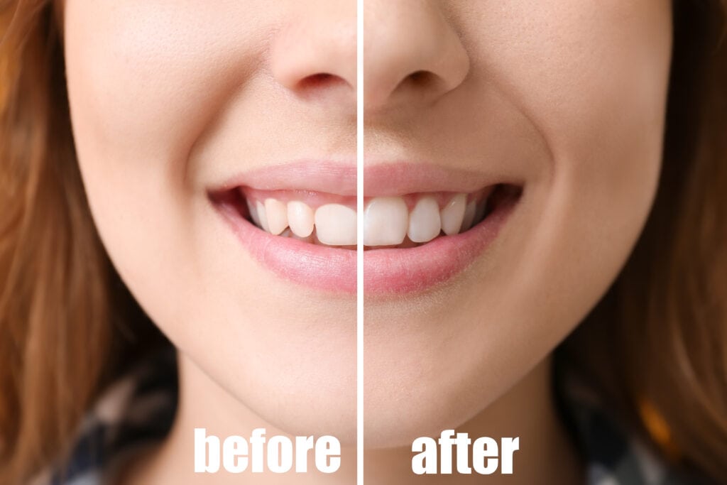 Young woman before and after procedure of gingival plasty, close