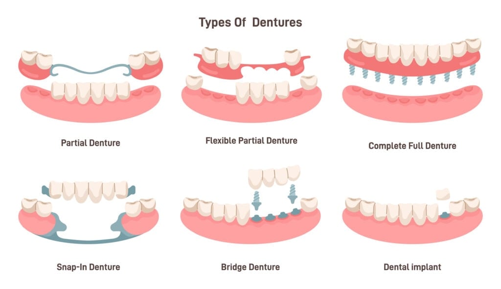 Dental prosthesis types set. Dental implant, partial, snap in, bridge