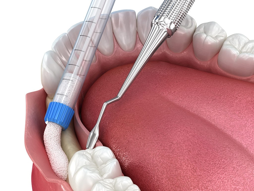 bone graft surgery