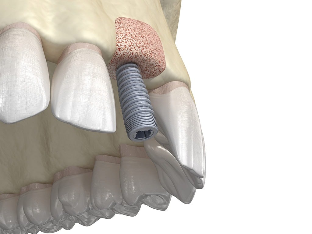 bone grafting augmentation