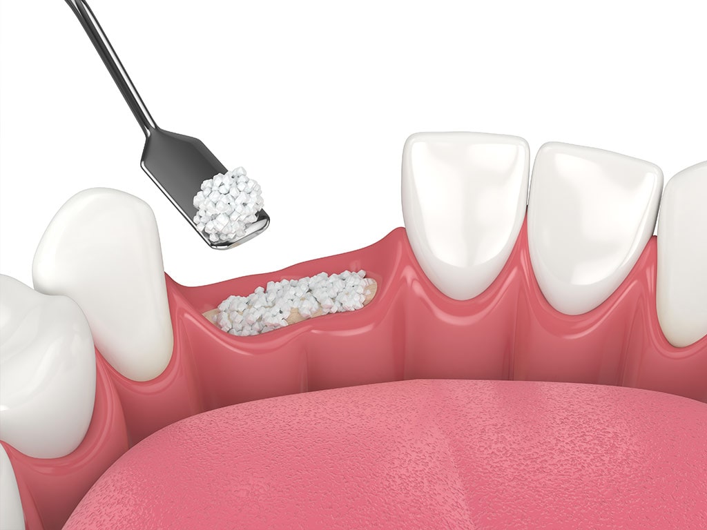 dental bone grafting with dental bone biomaterial