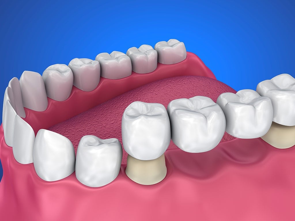 dental bridge