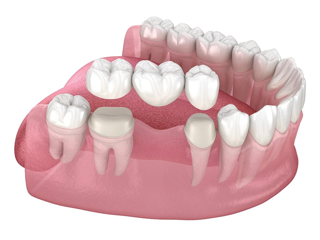 full mouth dental bridge