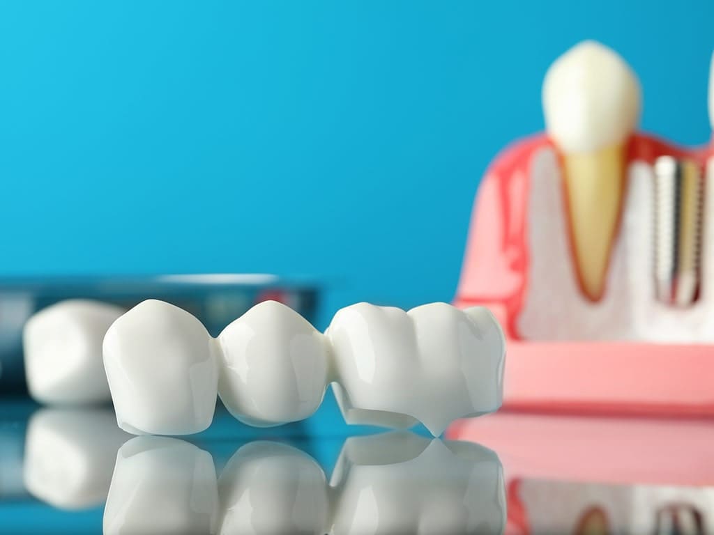 tooth bridge procedure
