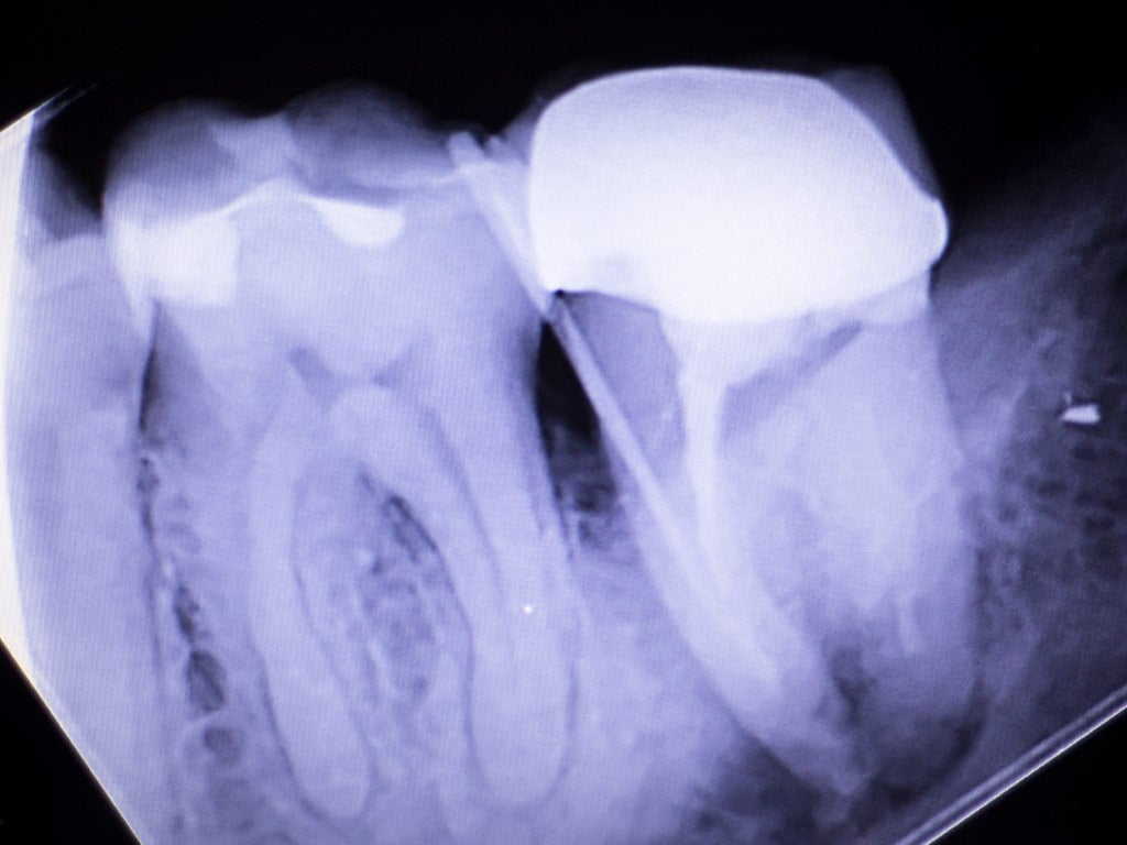 tooth root infection