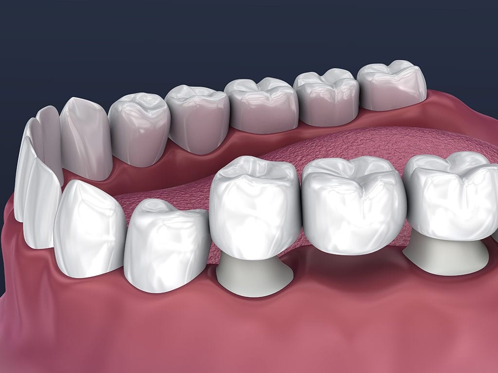 tooth supported fixed bridge of 3 teeth