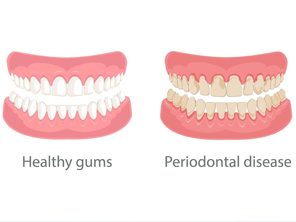 gum disease and teeth, periodontal disease