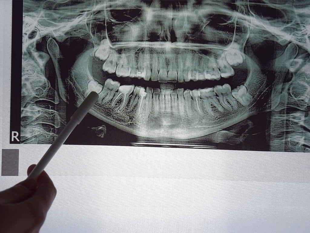 gum disease snapshot