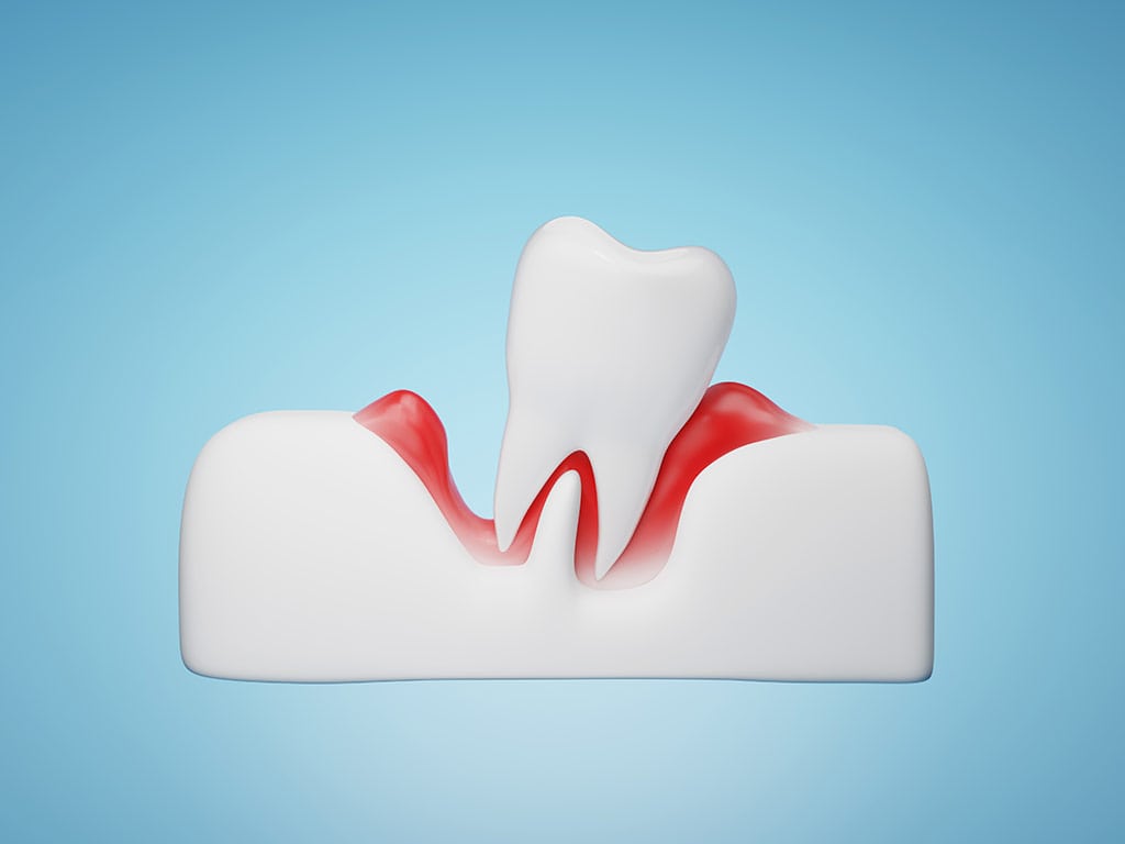 gums and teeth disease