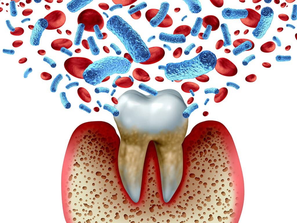 tooth decay and blood bacteria